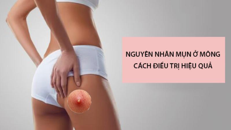 Các loại mụn ở mông