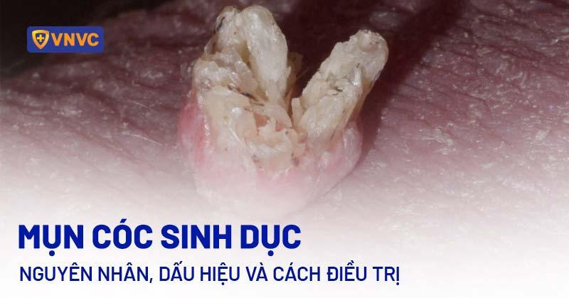 Hinh anh tong quan ve mun gai sinh duc nam, giup nhan dien hinh dang va vi tri thuong gap