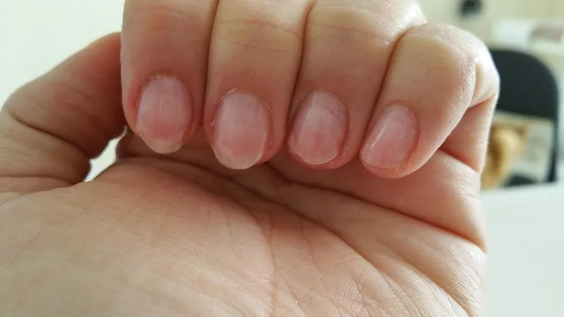 Hình ảnh móng tay yếu, dễ gãy do hóa chất tẩy rửa