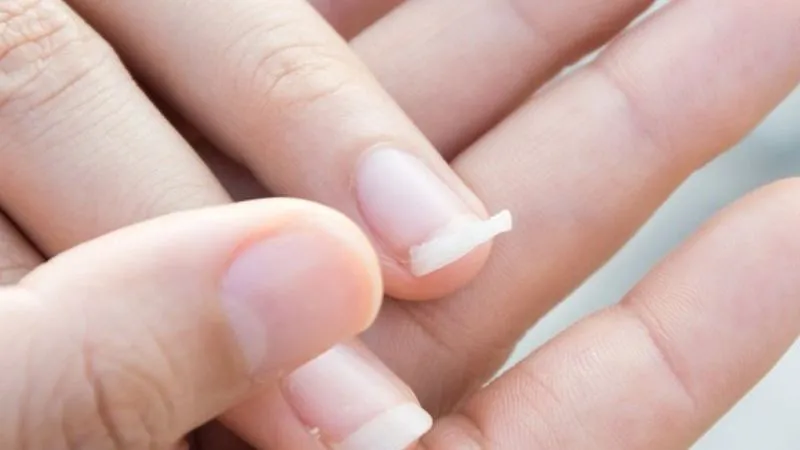 Người có cơ địa móng tay yếu và giòn cần chăm sóc đặc biệt