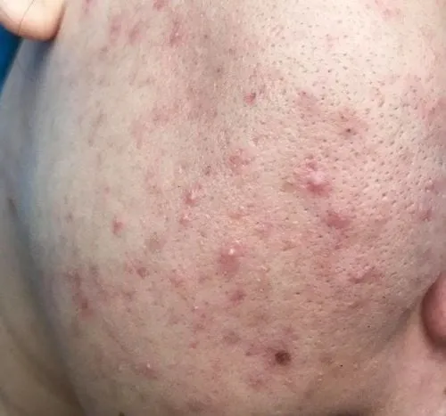 Lá lô hội tươi và gel lô hội hỗ trợ giảm mụn trứng cá hiệu quả